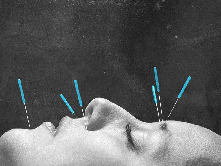 Acupuncture for Migraine: What to Know