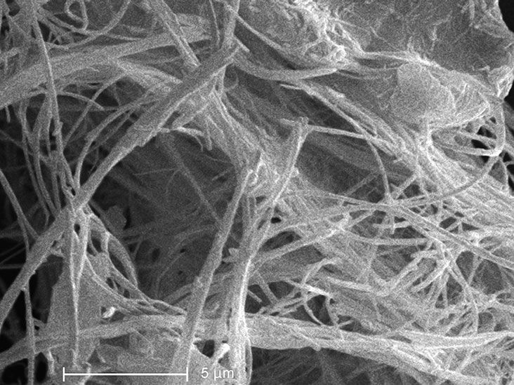 What Causes Asbestosis? Finding Asbestos and Living With Asbestosis