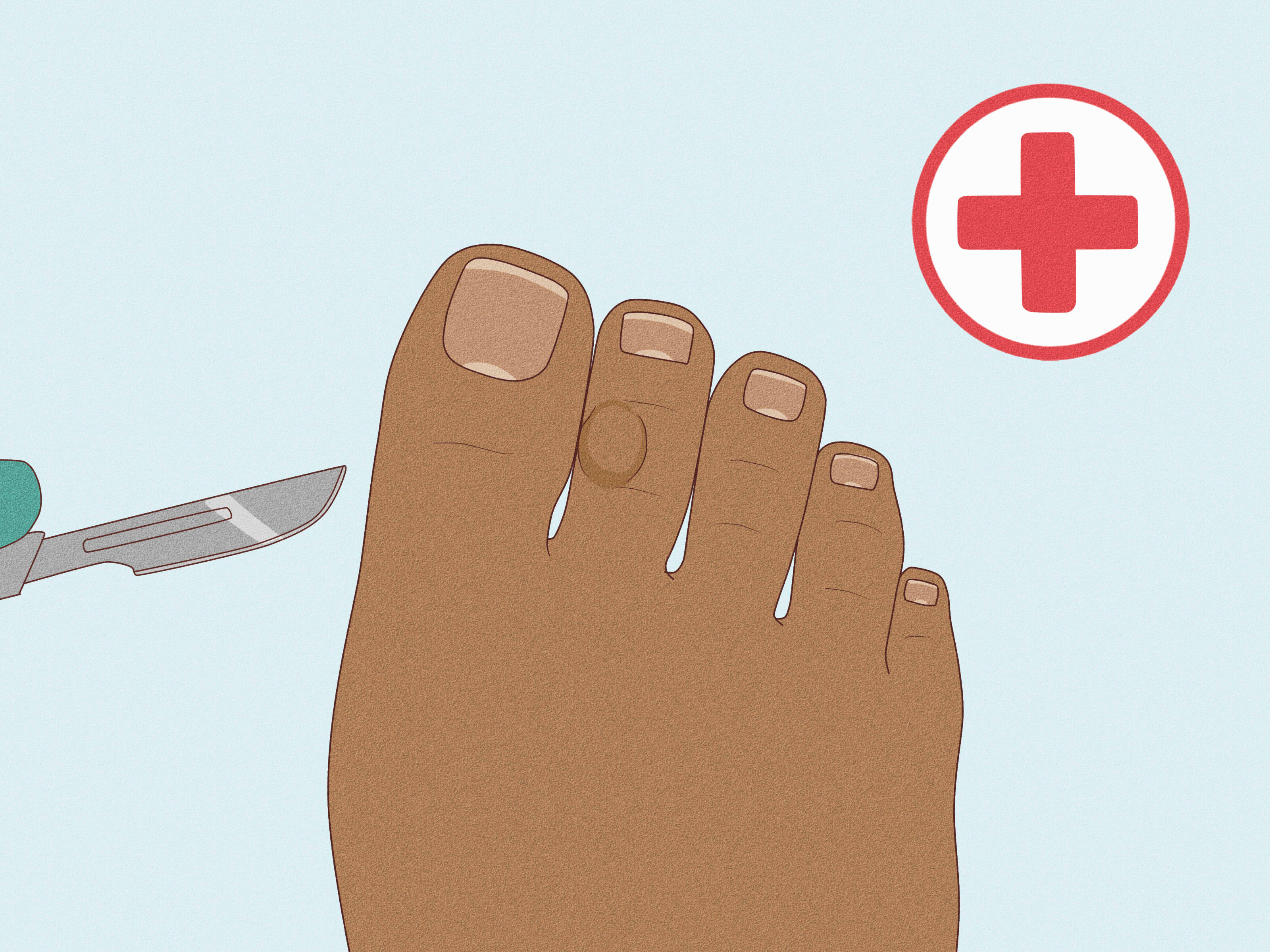 How to Remove Corns from Your Toes: 12 Steps