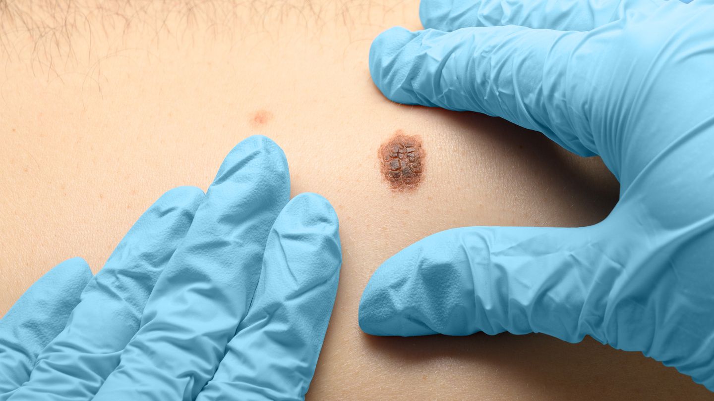 Melanoma Monday: The Truth About Skin Cancer