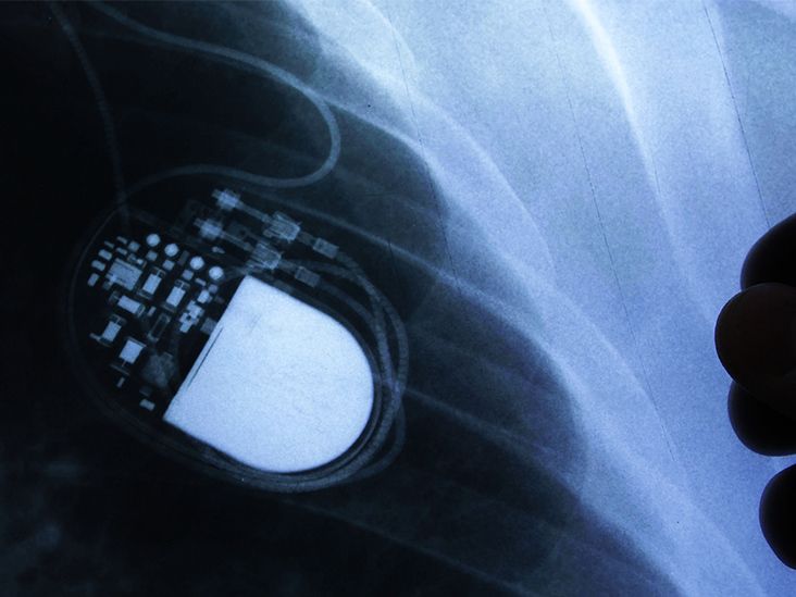 What Are Some Tips for Living With a Pacemaker?