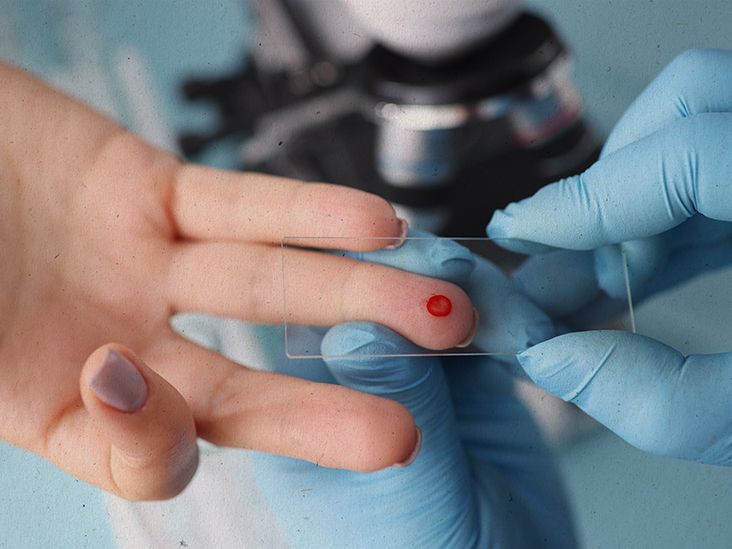 Poikilocytosis: Types, Symptoms, and Treatment