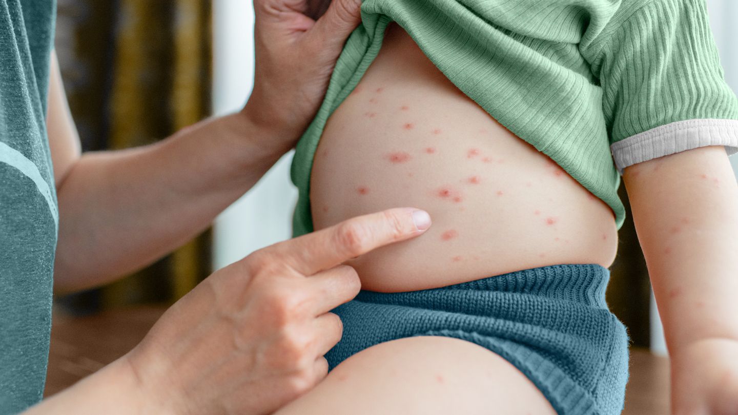 Cutaneous Mastocytosis: Symptoms, Causes, Diagnosis, and Treatment