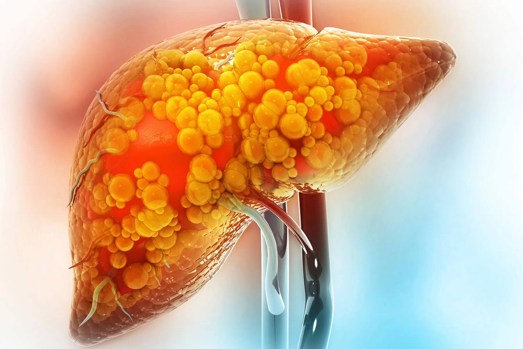 Alcohol-Related Liver Disease vs. Non-Alcohol-Related Liver Disease