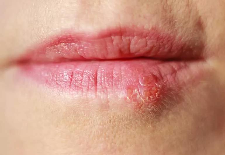 Cold Sore vs. Lip Pimple: What’s the Difference?