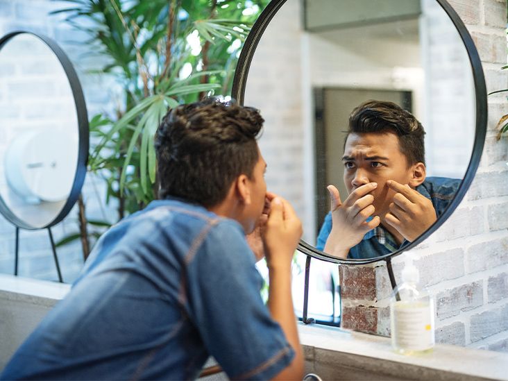Difference Between Acne and Pimples