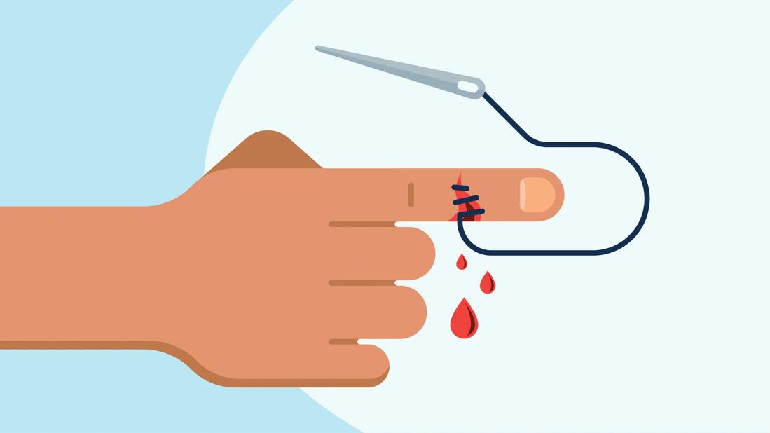 How Do You Know if You Need Stitches?