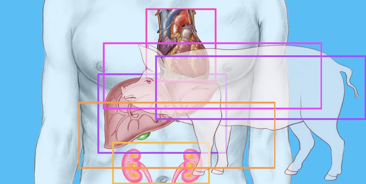 Recipient of First Genetically Modified Pig Heart Transplant Dies